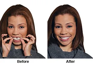 Snap On Smile Hillsborough NJ